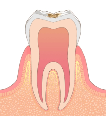 C1（エナメル質う蝕）
