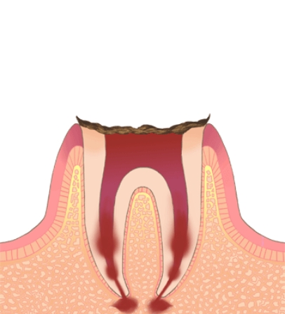 C4（歯の根まで進行）