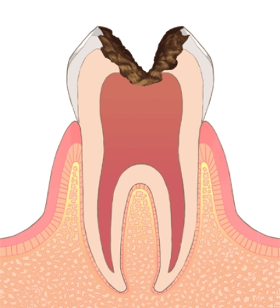 C3（神経までのう蝕）