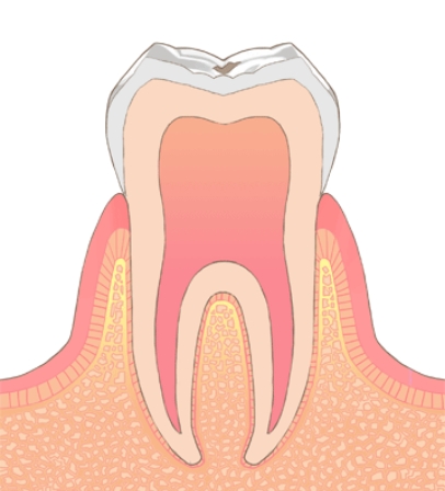 C0（初期むし歯）